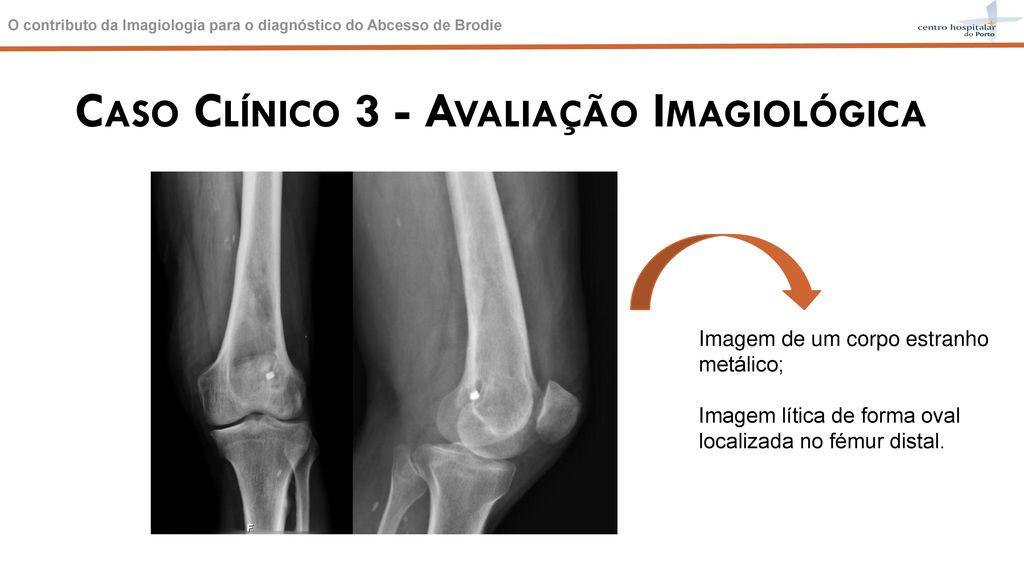 O contributo da Imagiologia para o diagn stico do Abcesso de